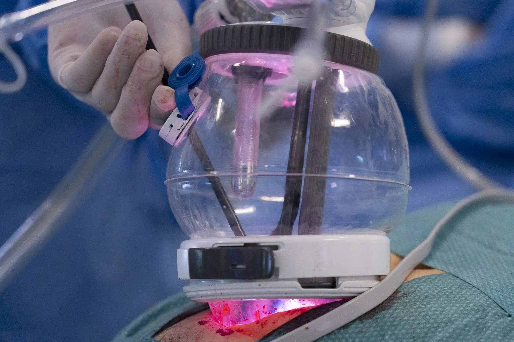 Primer plano del dispositivo de puerto único colocado sobre el abdomen del paciente, por el que entran todos los instrumentos del robot