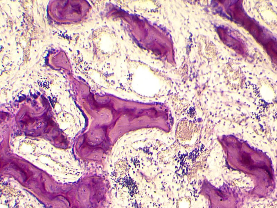 Imagen de microscopio de hueso esponjoso: trabéculas moradas rodeadas de células de la médula ósea