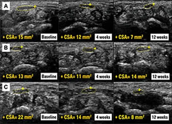 Ecografías del nervio mediano en tres pacientes, al inicio, a las cuatro semanas y a las doce semanas, con su área marcada en amarillo